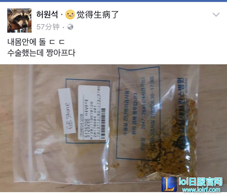 Pawn手术完毕 取出的胆结石触目惊心